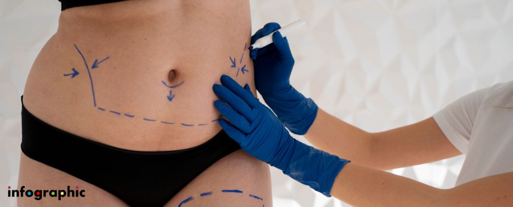 טכנולוגיות חדשות בשאיבת שומן – לייזר, BodyTite ו-J-Plasma ובצד שמאל למטה לוגו אתר infographic